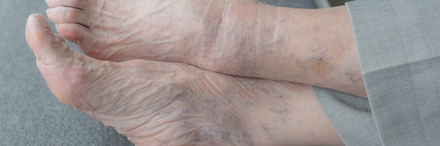 Arthritis Toe